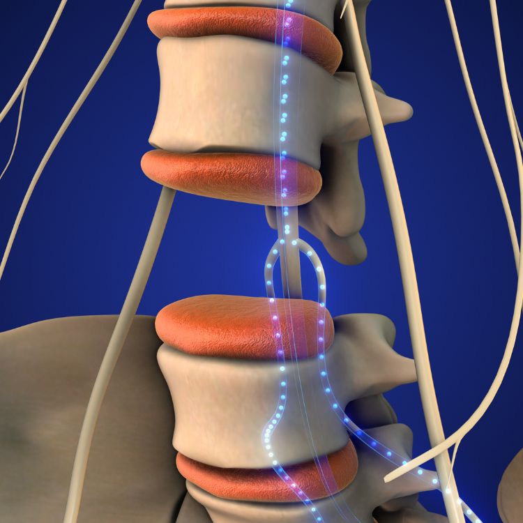 An illustration of a spinal cord stimulator.