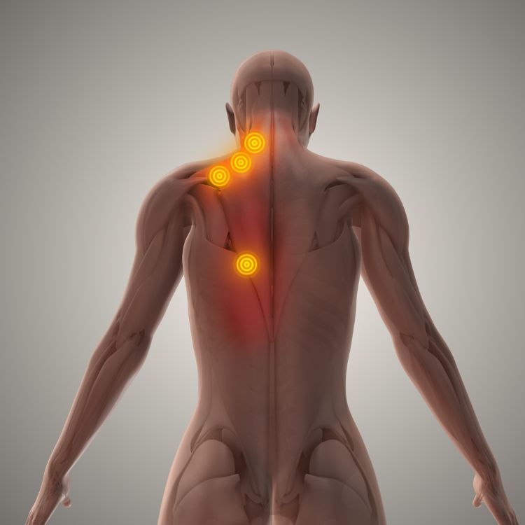 A human body, highlighting trigger point injections on his neck and back.